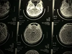 叔母のCTスキャン